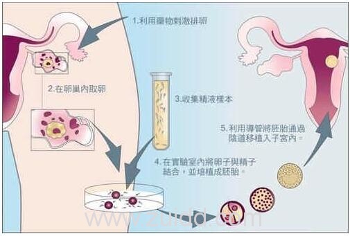 揭秘试管婴儿的具体流程及全部费用